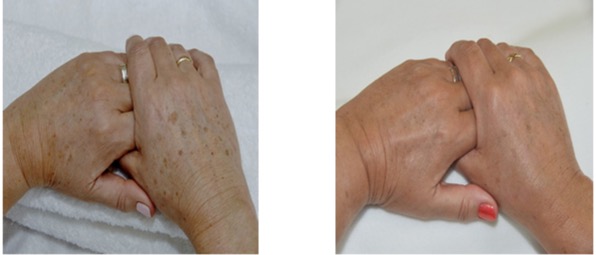 Pigmentation, sun spots